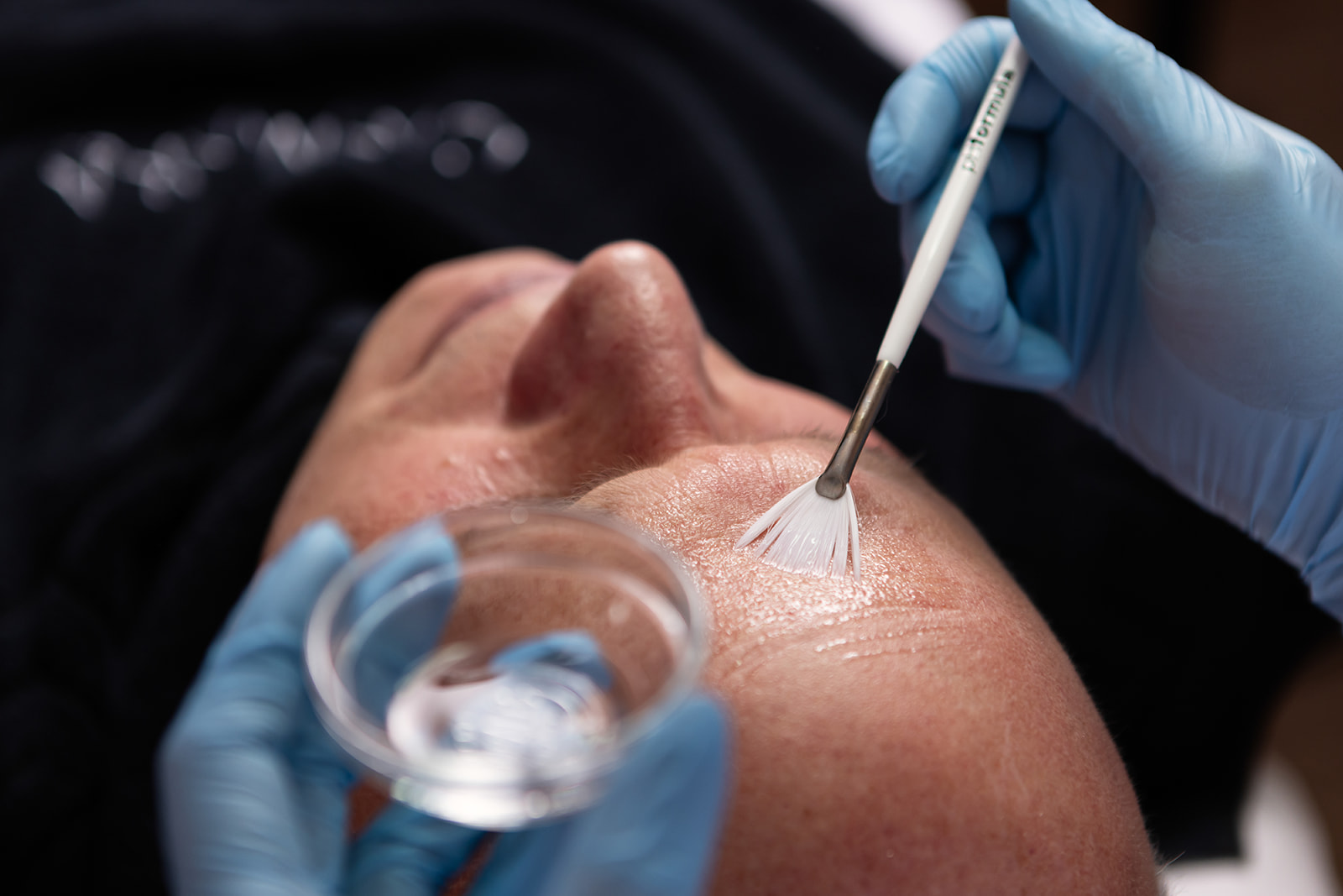 Peeling Season bij Perfect Skin Institute