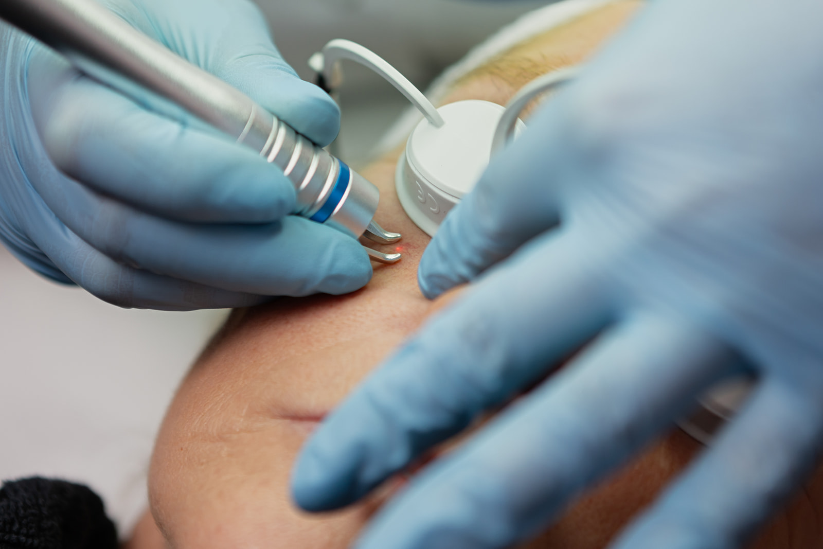 Laser Gezichtsverbetering met Geavanceerde Technologie