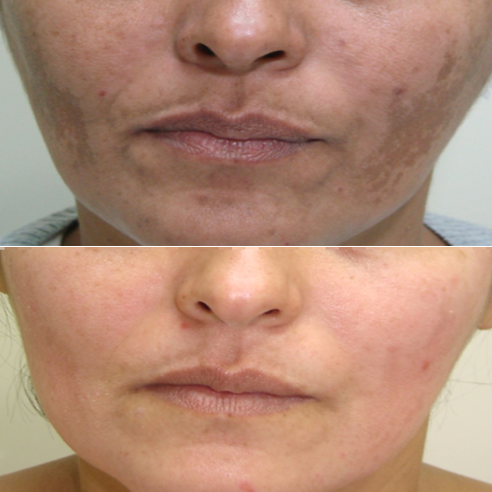 VOOR_NA_MELASMA-1-meline